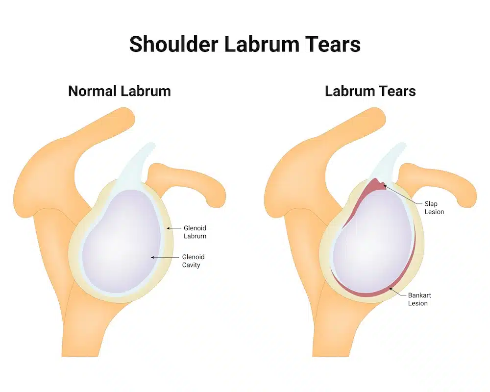 Labrum Tear Shoulder Workers Comp Settlement - Kitay Law Offices