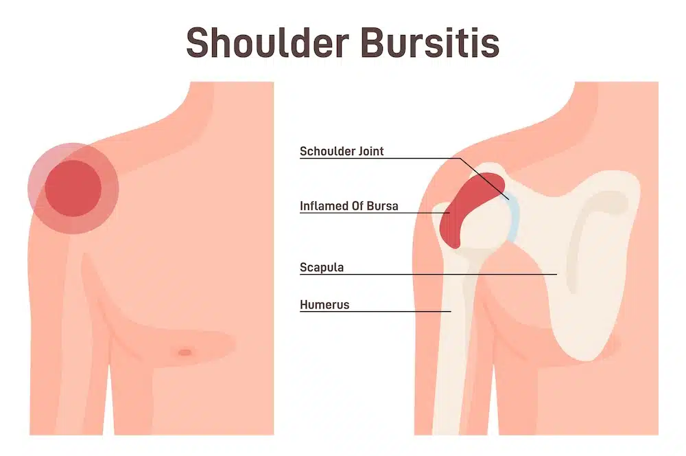 Shoulder Injury Settlement without Surgery - Kitay Law Offices