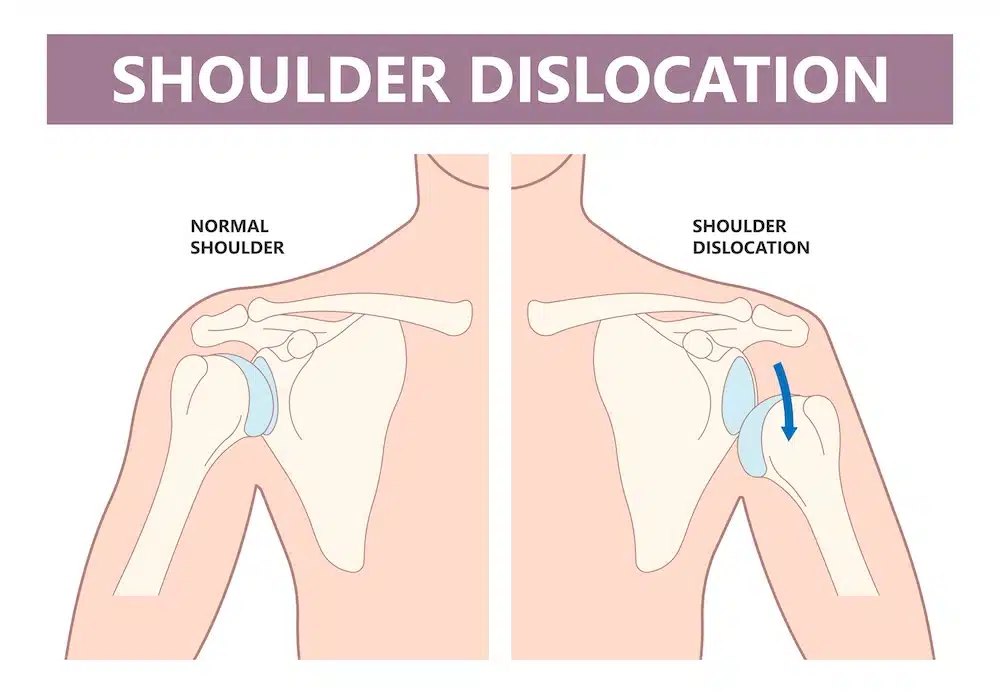 Workers' Compensation for Shoulder Injury Requiring Surgery - Kitay Law Offices