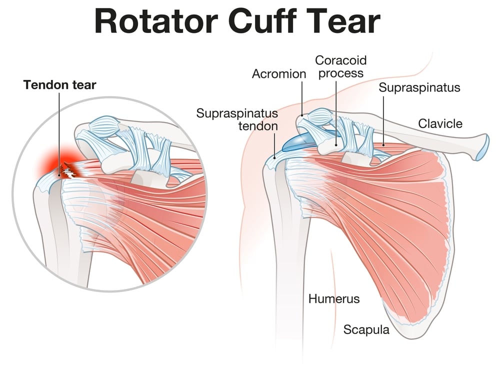 Shoulder Surgery Workers' Comp Settlement - Kitay Law Offices